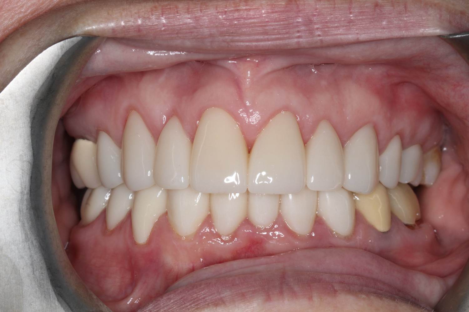 Smile gallery result 1 after treatment