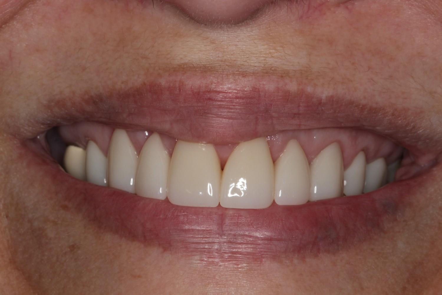 Smile gallery result 2 after treatment