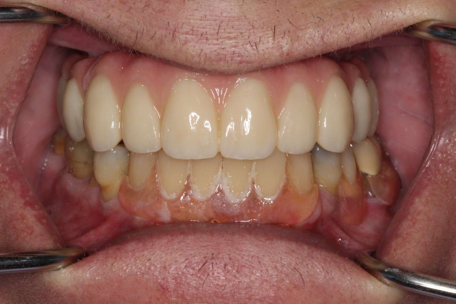 Smile gallery result 3 after treatment