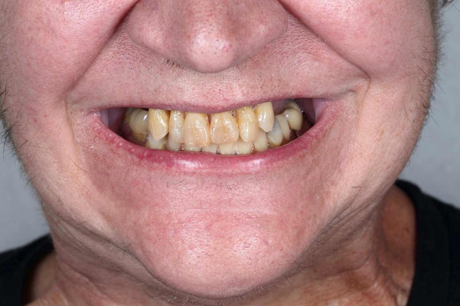 Smile gallery result 4 after treatment