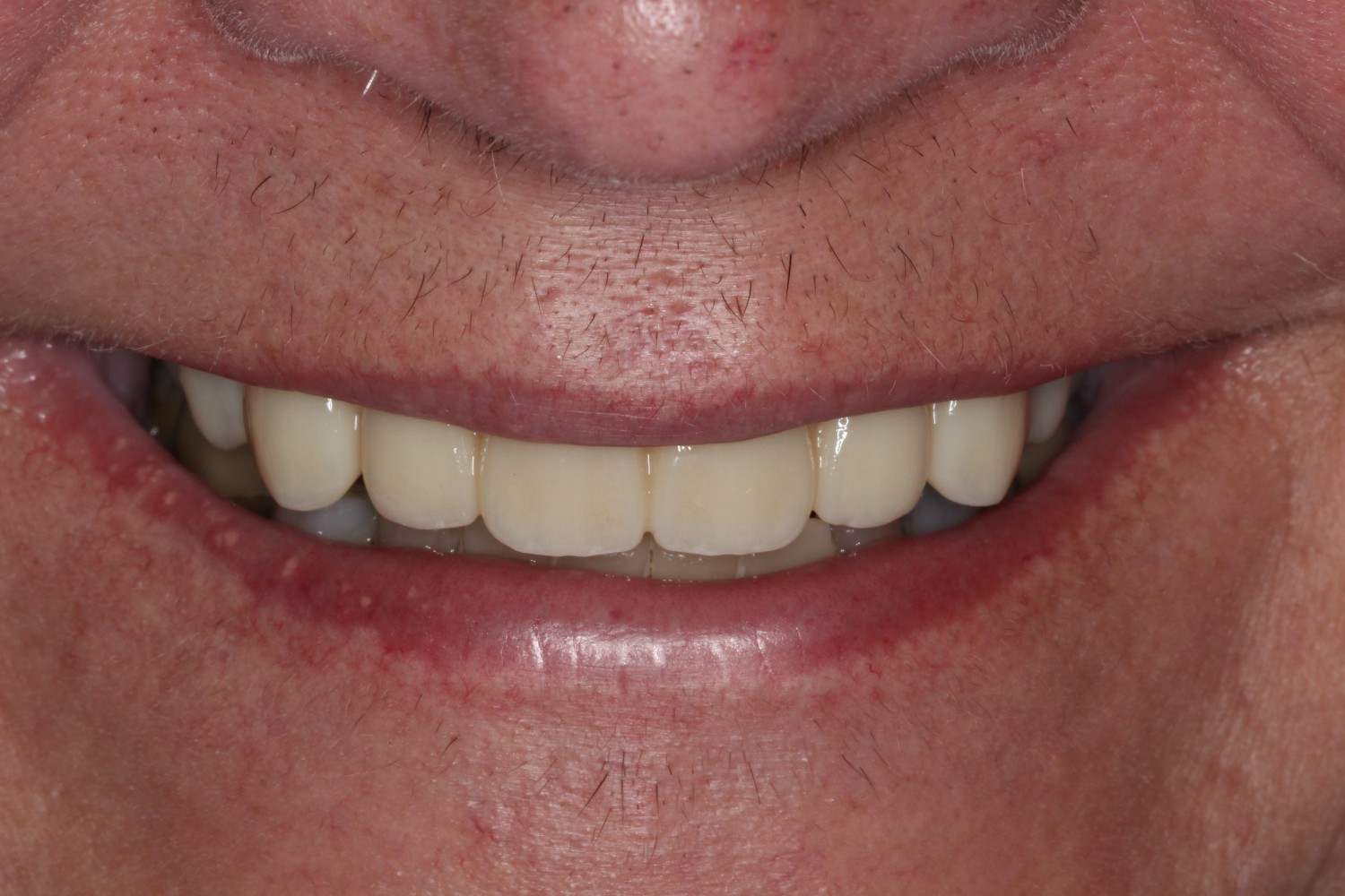 Smile gallery result 6 after treatment