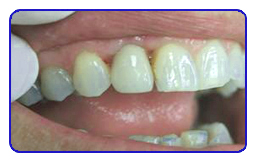 Smile gallery result 5 after treatment