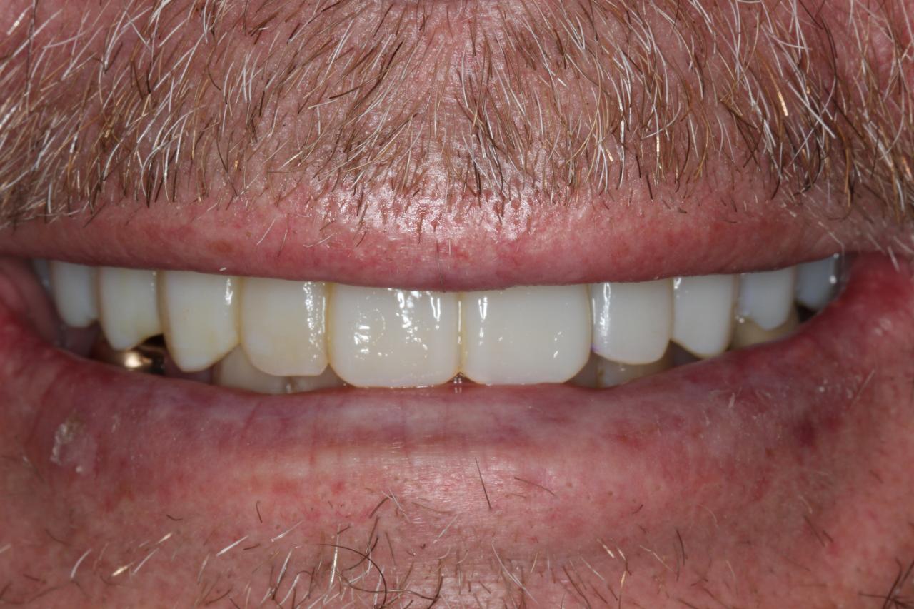 Smile gallery result 7 after treatment