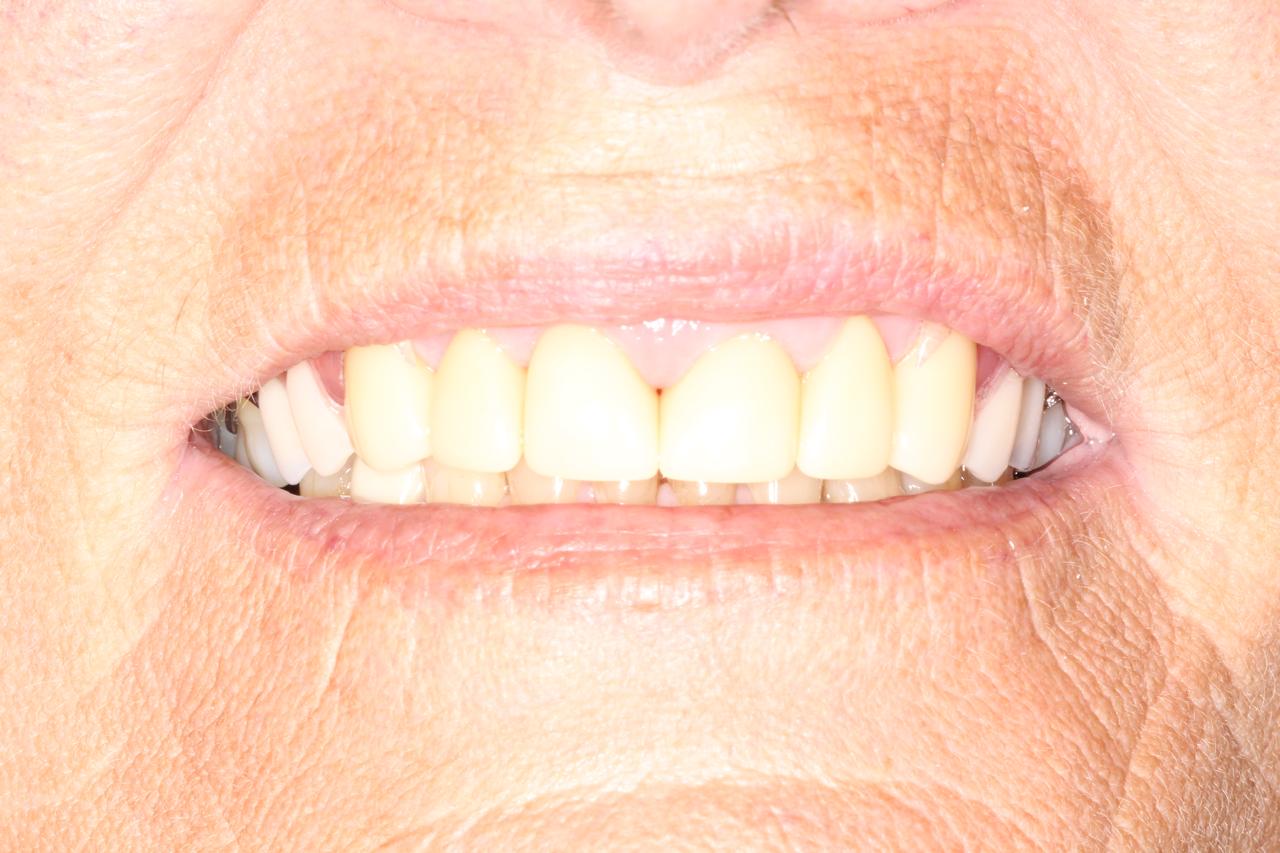 Smile gallery result 9 after treatment