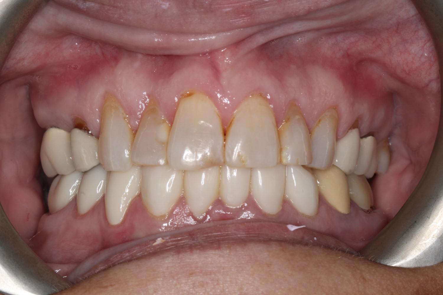 Smile gallery result 1 before treatment