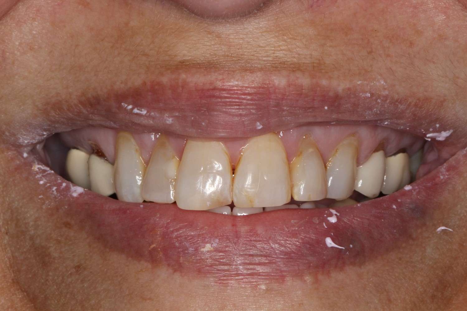 Smile gallery result 2 before treatment