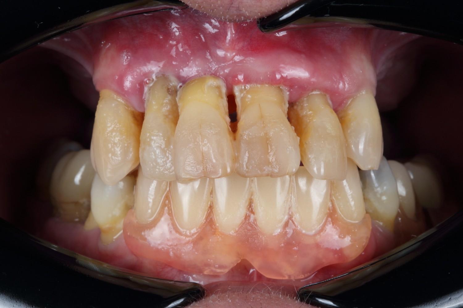Smile gallery result 3 before treatment
