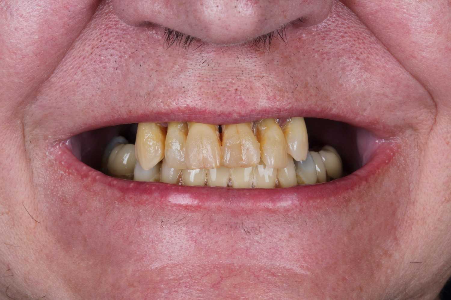 Smile gallery result 4 before treatment