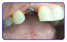 Smile gallery result 5 before treatment