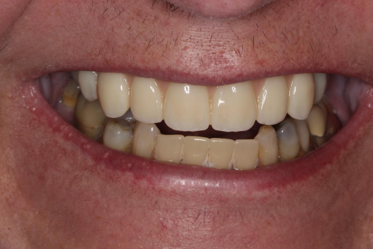 Smile gallery result 6 before treatment