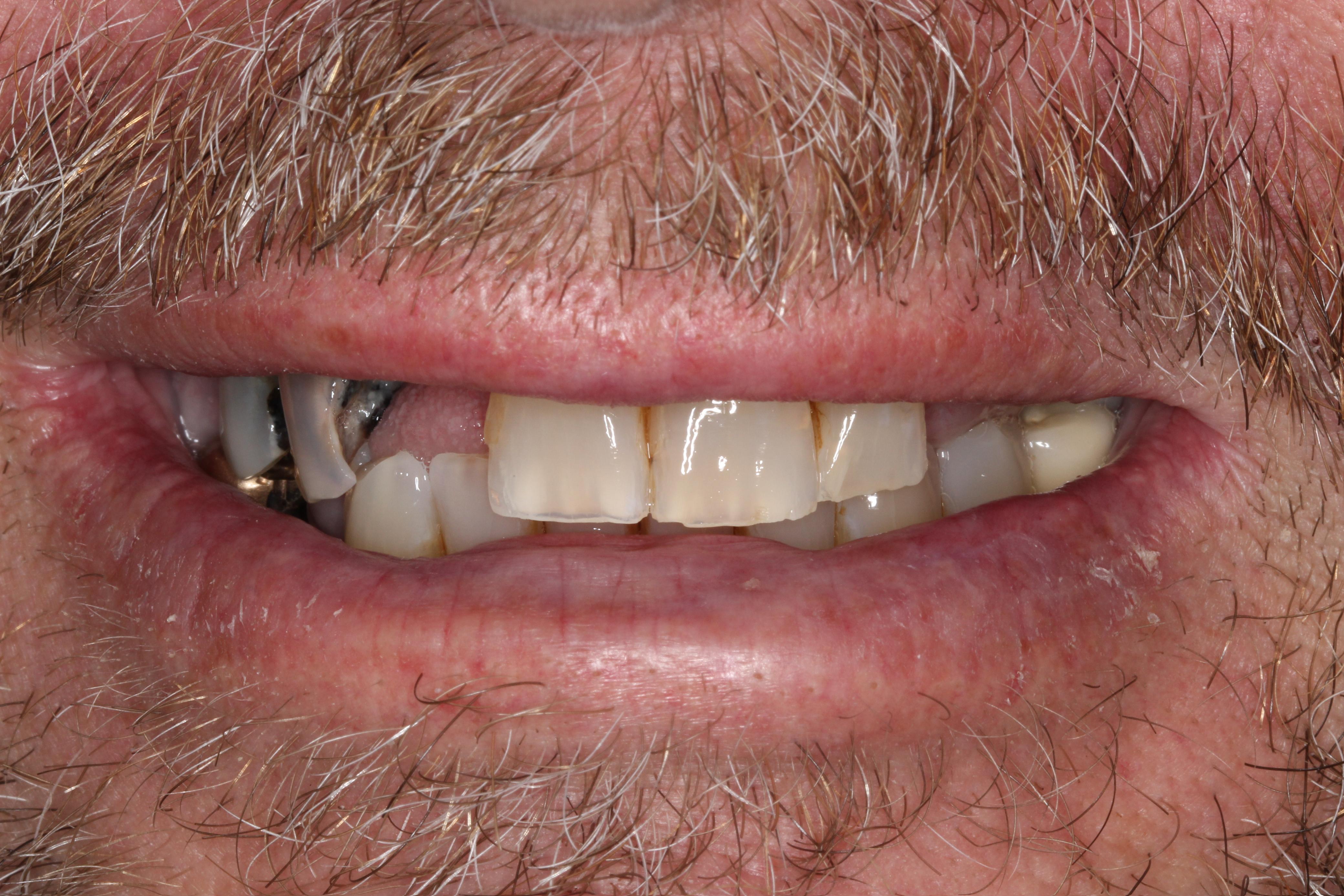Smile gallery result 7 before treatment
