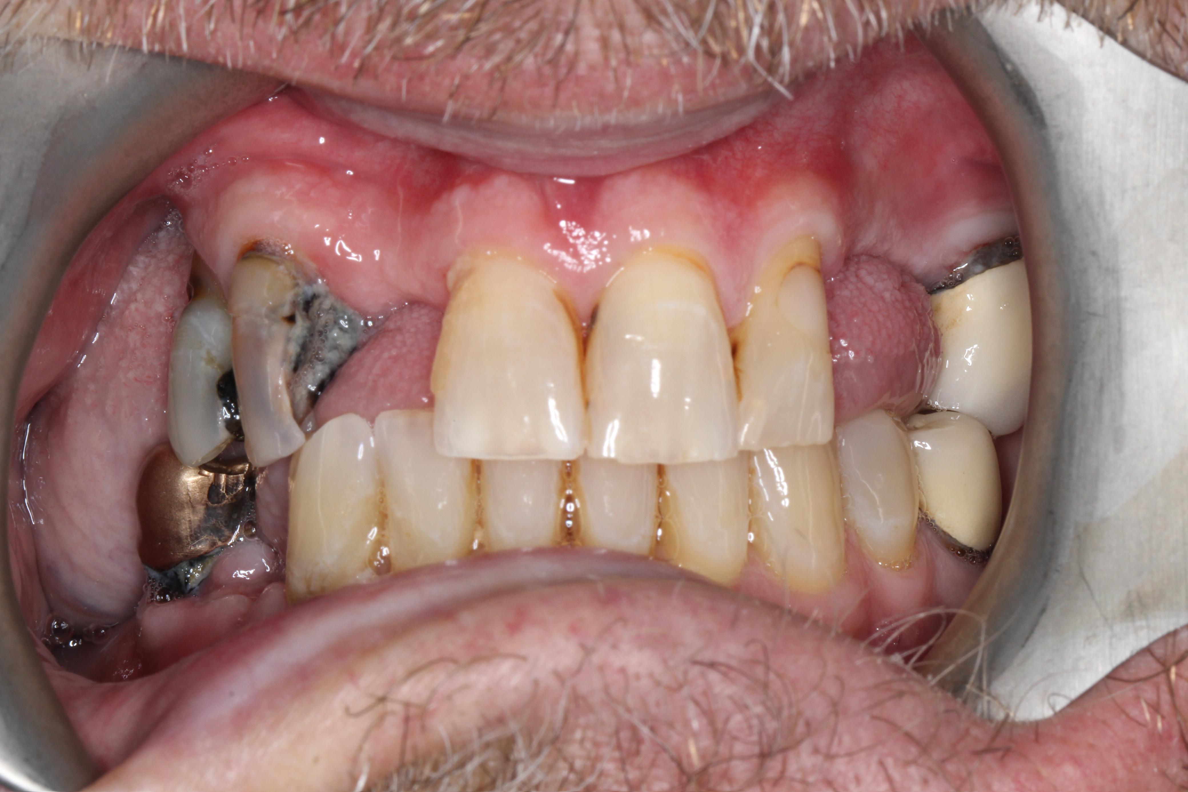 Smile gallery result 8 before treatment